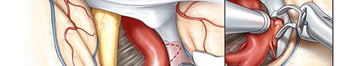 Posterior Communicating Artery Aneurysm Clipping