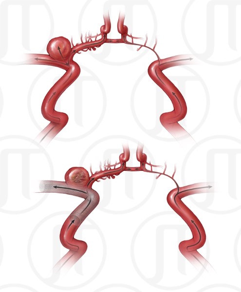 Internal Carotid Artery Flow Diverter