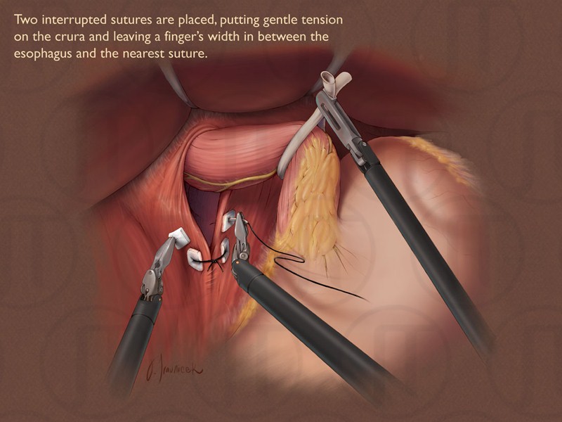 Nissen Fundoplication with Cruroplasty