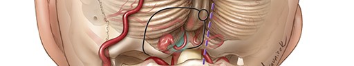 Occipital Artery Bypass