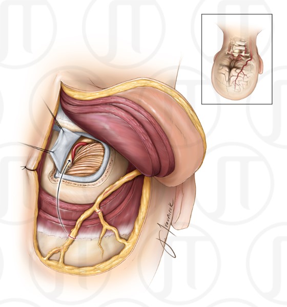 Occipital Artery Bypass