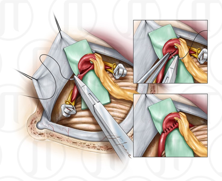 Occipital Artery Bypass