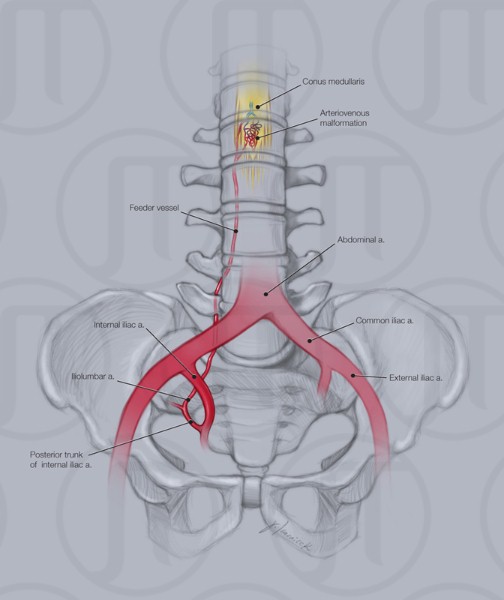 Spinal AVM