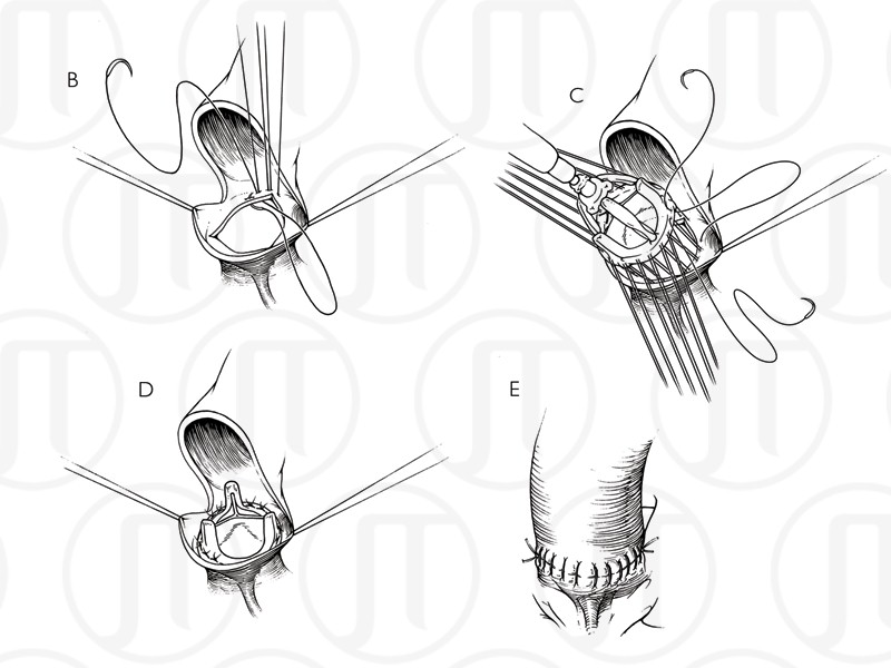 Aortic Valve Replacement