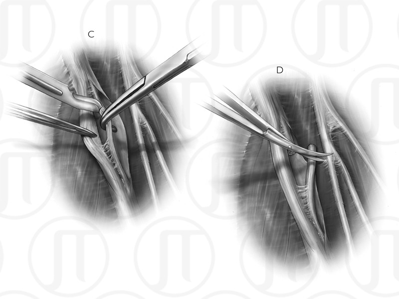 Anterior Interosseous Nerve Repair