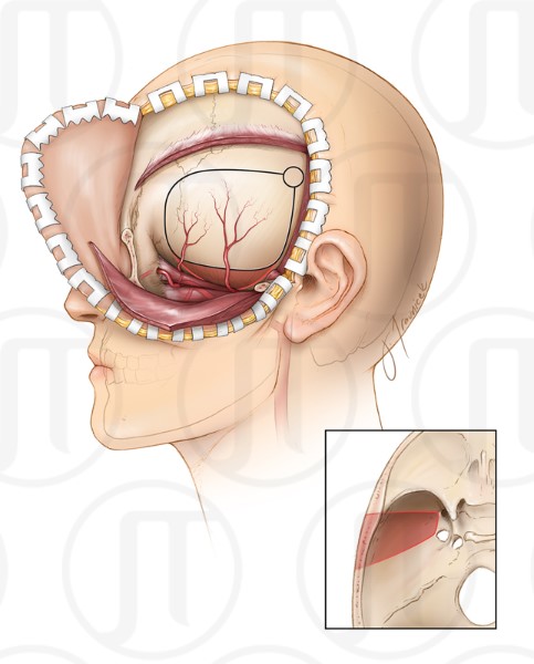 Internal Maxillary Artery Bypass