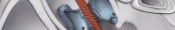 Aortic Valve Replacement: Supplement