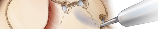 Posterior Petrosectomy Craniotomy