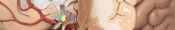 Endoscopic Ventriculostomy