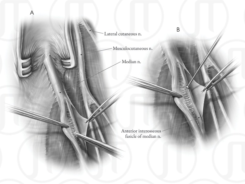 Anterior Interosseous Nerve Repair