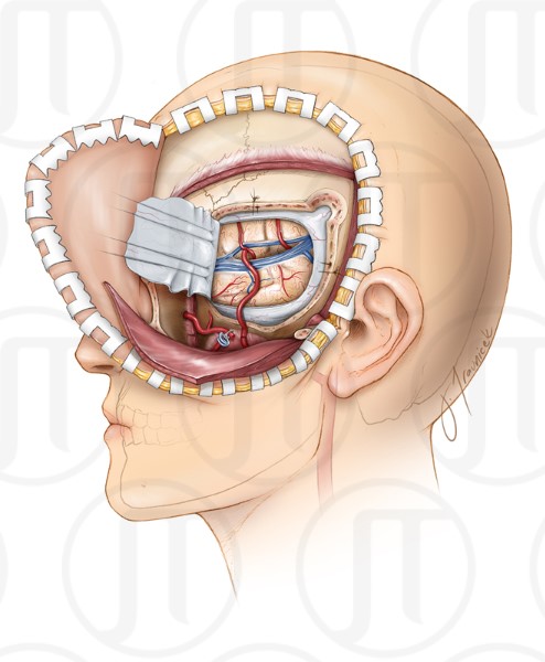 Internal Maxillary Artery Bypass