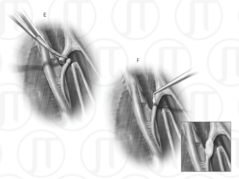 Anterior Interosseous Nerve Repair