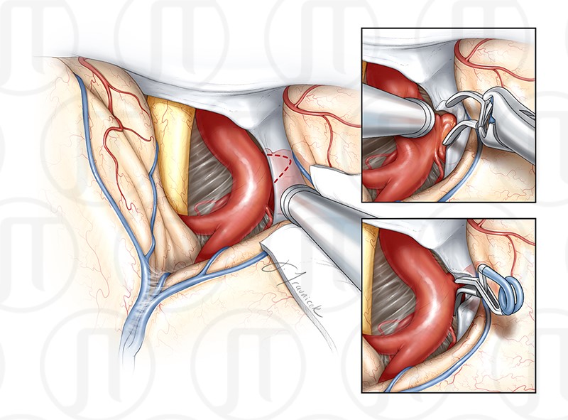 Posterior Communicating Artery Aneurysm Clipping