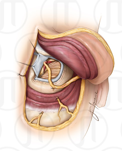 Occipital Artery Bypass