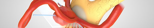 Superior Pointing Acomm Aneurysm Variations