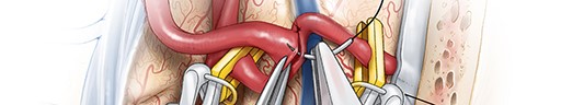 Internal Maxillary Artery Bypass