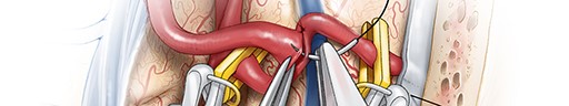 Internal Maxillary Artery Bypass