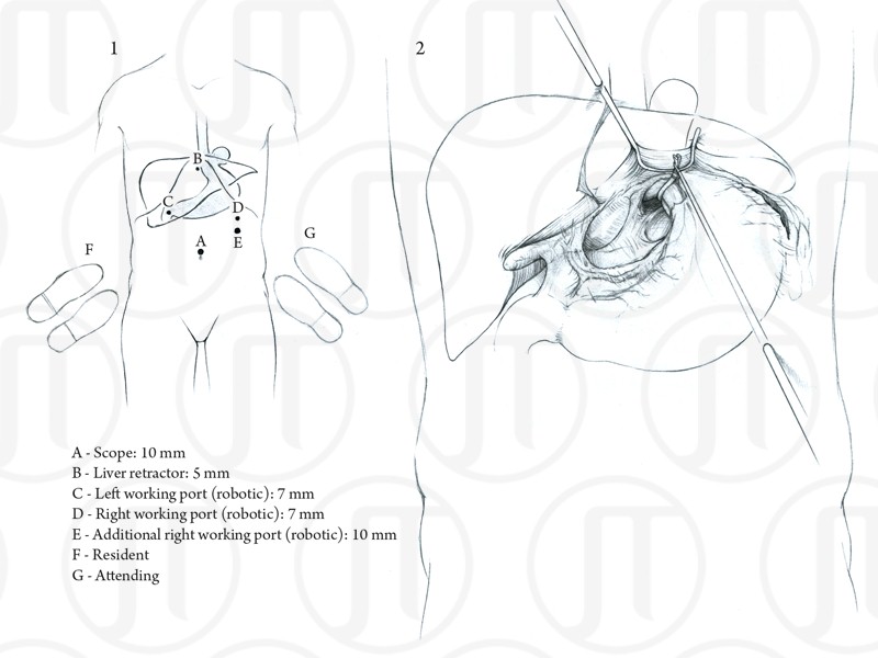 Nissen Fundoplication with Cruroplasty