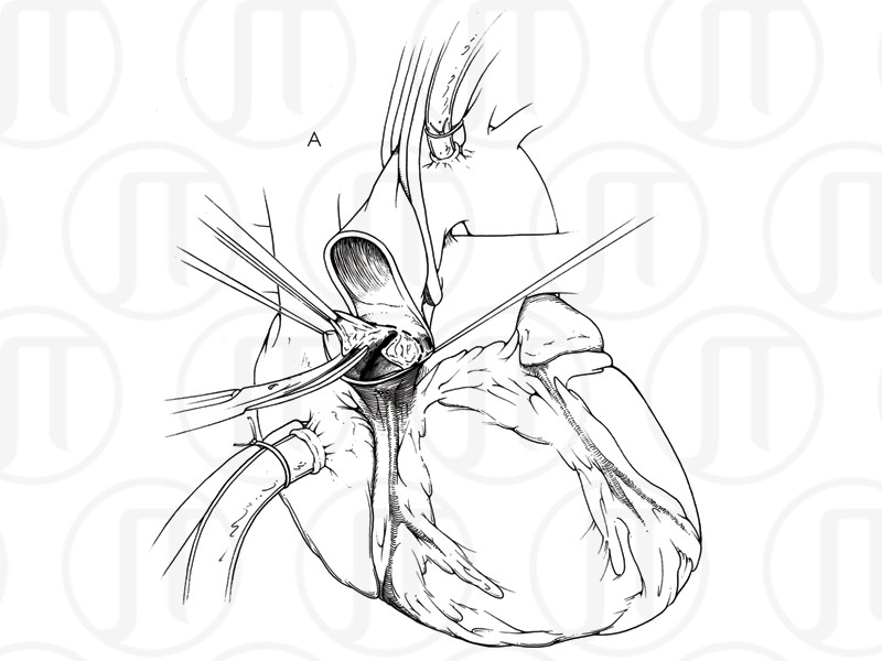 Aortic Valve Replacement