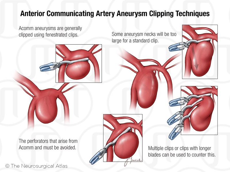 Anterior Communicating Artery Aneurysm Clipping