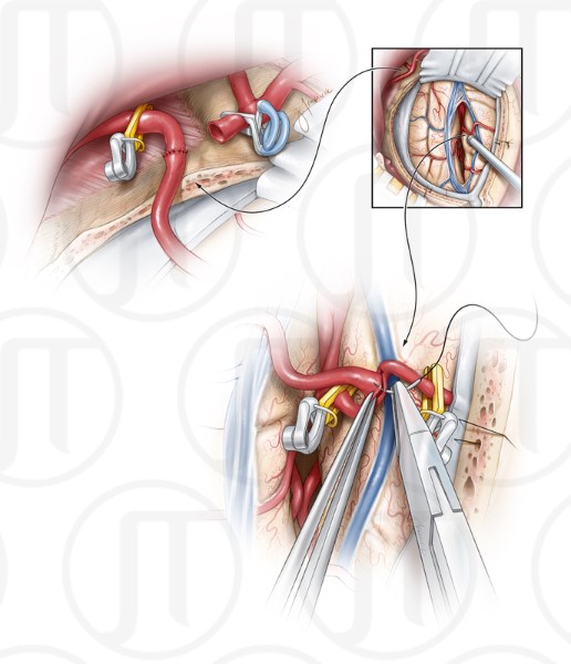 Internal Maxillary Artery Bypass