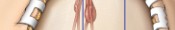 Pericallosal Artery Aneurysm